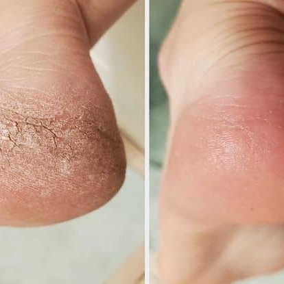 Tratamiento de callosidades